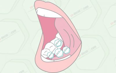 Como hacer un aborto con pastillas – uso sublingual